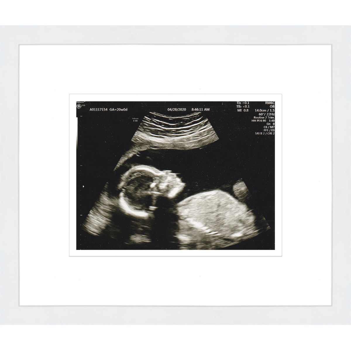 White Sonogram Frame with Double Mats Frames for Ultrasound Images